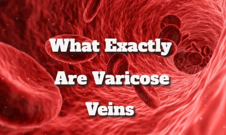 Veins Varicose What Exactly Are Varicose Veins